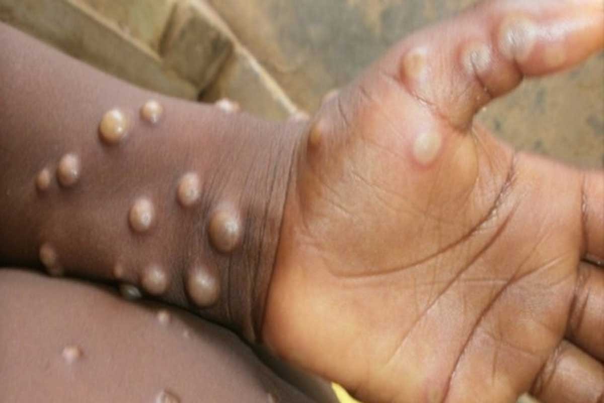 Monkeypox death Kerala