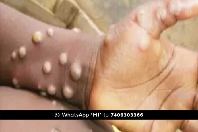 Kerala on high alert after India’s second mpox case