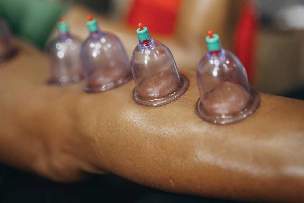 Cupping Therapy for Pain Relief