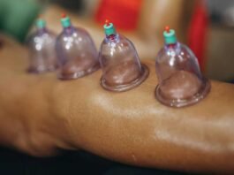 Cupping Therapy for Pain Relief