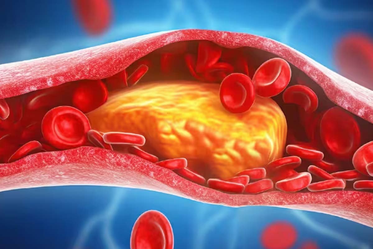 Cholesterol Cholesterol