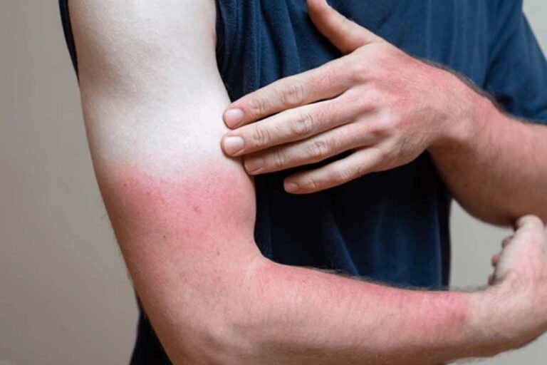 Sunburn